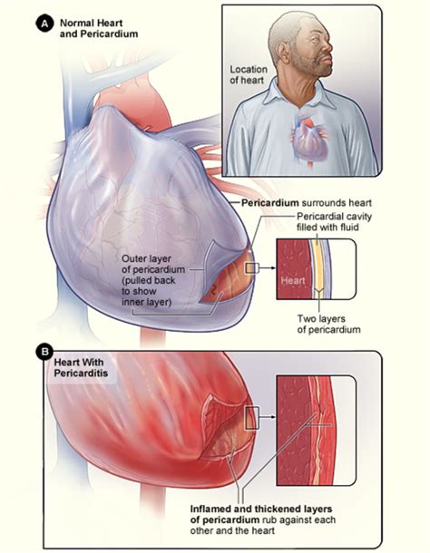 What You Need To Know About Pericarditis Hubpages