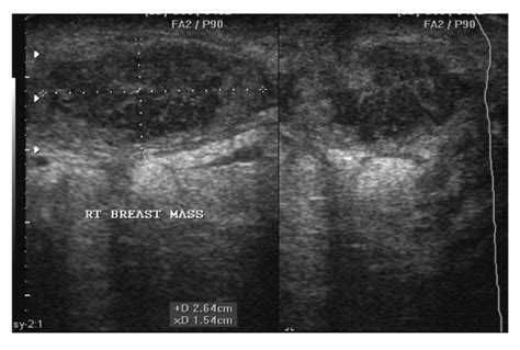 A Sonogram Of A 22 Yrs Old Female Showing A Right Breast Abscess Note