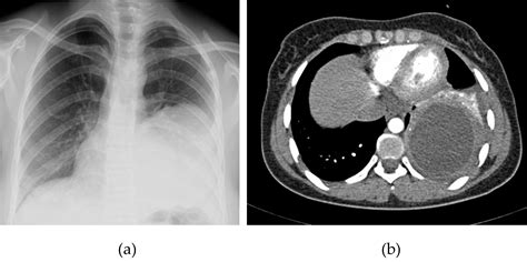 Radiological Characteristics Of Pulmonary Hydatid Cysts Intechopen