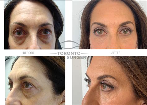Brow Lift Toronto Eyelid Surgery
