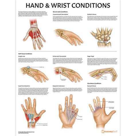 Hand And Wrist Conditions Poster Hands Fingers Pathology Chart