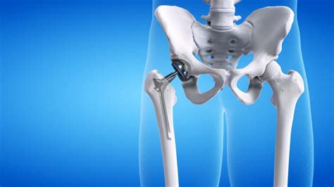 Total Hip Replacement Rehab Exercises Physio Logical