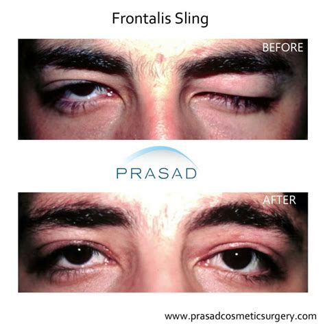 Ptosis Surgery Droopy Eyelid New York Specialist