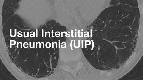 Usual Interstitial Pneumonia Uip Youtube