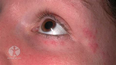 Case Red Spots Around Eyes With Rhinitis History — Dermnet