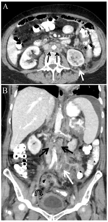 Abdominal Ct Scan With Intravenous Contrast In Jection Para Aortic
