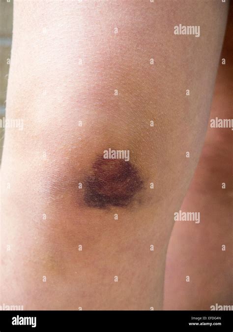 Injury Bruised Knee Stock Photo Alamy
