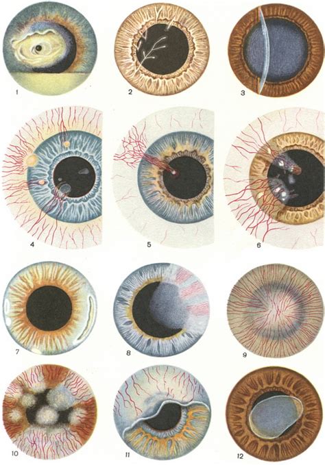 Important forms of keratitis include bacterial, herpes zoster, herpes simplex, and acanthamoeba ke. Keratitis herpes tuberculosis ulcer treatment