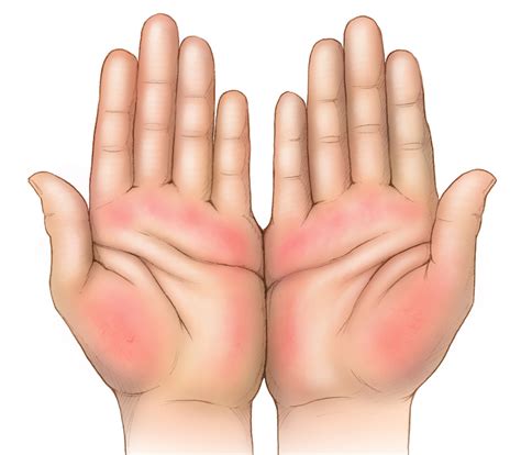 It happens whenever blood vessels in the hand become dilated. Core Concepts - Initial Evaluation of Persons with Chronic ...