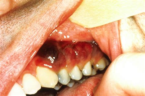 Hiv Mouth Sores Pictures Causes Treatment And Prevention