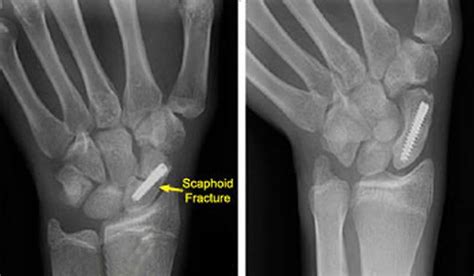 current methods of diagnosis and treatment of scaphoid fractures my xxx hot girl