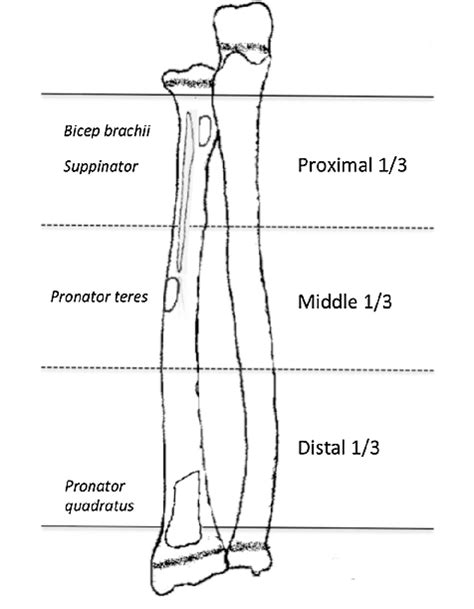 Image Showing The Breakdown Of Diaphyseal Forearm Fractures Into Three