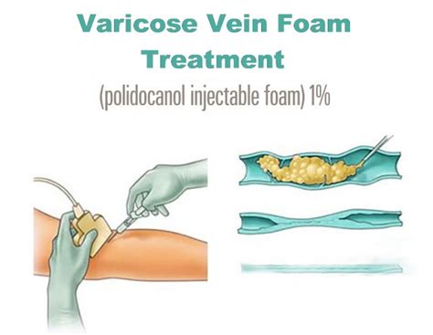 Varicose Vein Foam Treatment Vein Specialists Of The Carolinas
