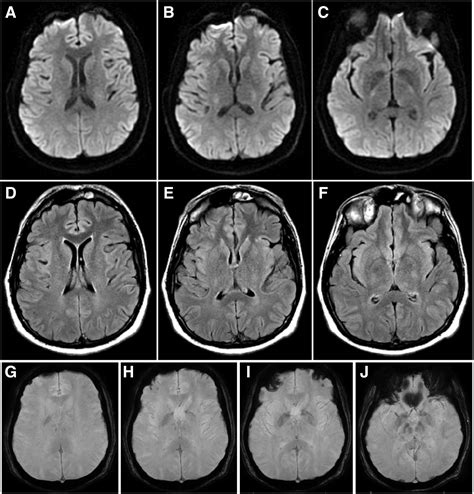 Delayed Onset Mri Findings In Acute Chorea Related To Anoxic Brain