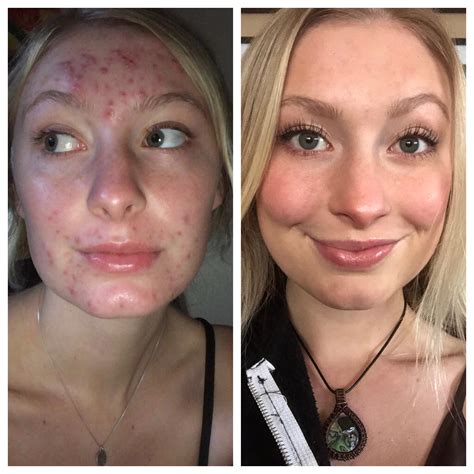 Officially 1 Month Post Accutane Info In The Comments This Pic Is