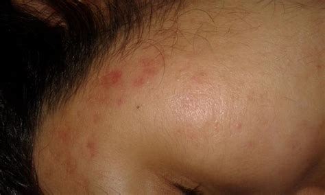 Deep Pitted Acne Scars Forehead And Chin Acne And Hereditary Facial