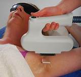 How Many Treatments Does It Take For Laser Hair Removal Images