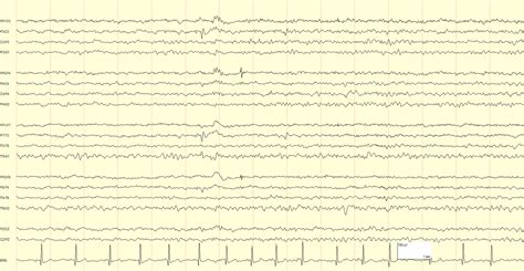 Childhood Epilepsy With Centrotemporal Spikes