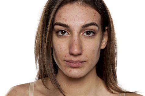 The Real Reasons We Get Adult Acne And How To Treat It