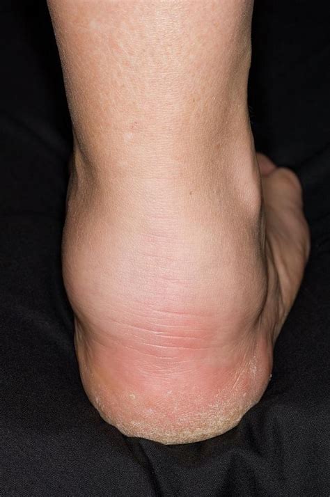 Swollen Ankle From Vasculitis Photograph By Dr P Marazzi Science Photo Library