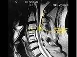 4 Level Cervical Fusion Recovery