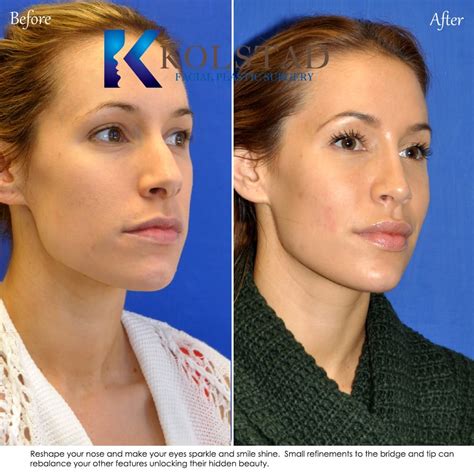 Wide Bridge Nose Job Before And After Gallery 1 Dr Kolstad San Diego