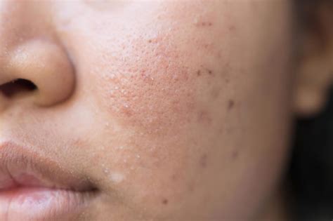 Bad Habits That Make Acne Scars Worse Readers Digest