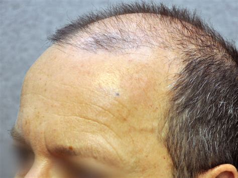 Hair Transplants Busting Some Common Myths Toronto Clinic