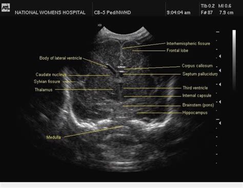 Fetal Head Anatomy Ultrasound