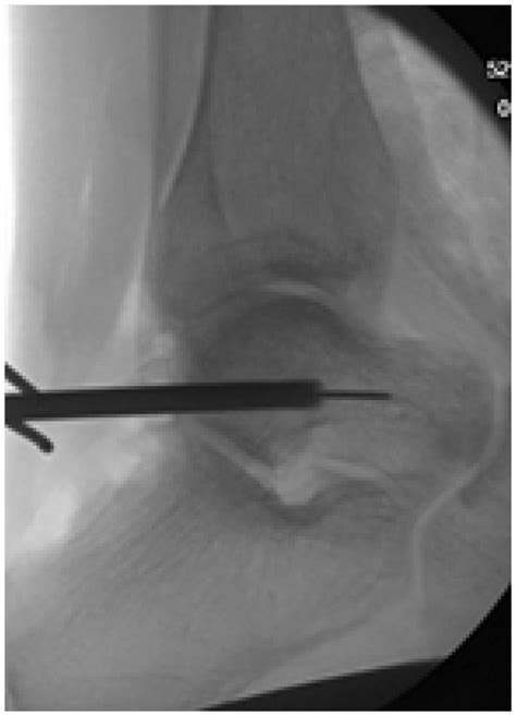 3D Printed Total Talus Replacement After Free Vascularized Medial