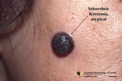 Seborrheic Keratosis Symptoms Cosmetic Care Viquepedia