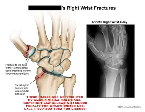 Right Wrist Fractures