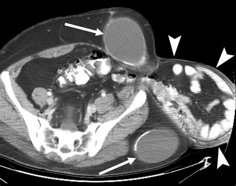 Abdominal Wall Hernias Imaging Features Complications And Diagnostic