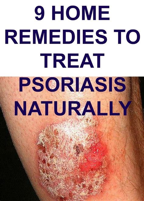 9 Home Remedies To Treat Psoriasis Naturally Treat Psoriasis Plaque Psoriasis Treatment