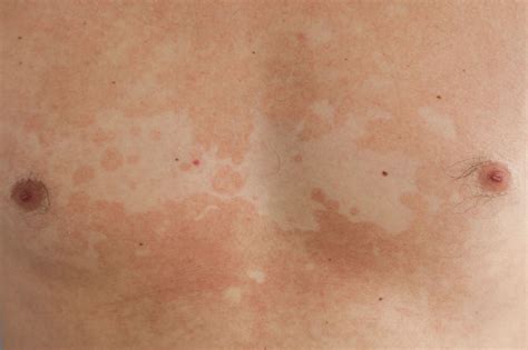 What Is Tinea Versicolor Fungal Infection Ayurvedic Treatment For