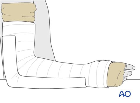 Cast Immobilization For Avulsion Ofby The Lateral Collateral Ligament
