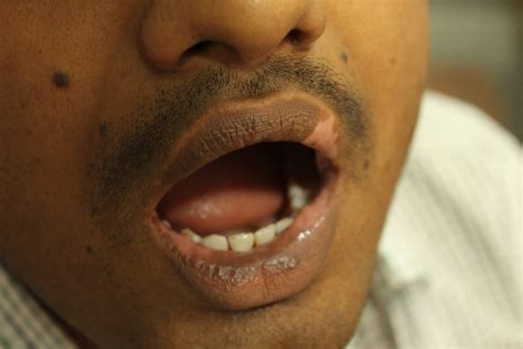 Vitiligo Lips Images