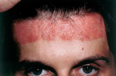 Forehead Rashes In Adults