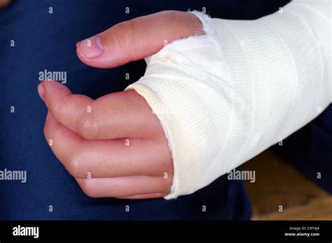 Broken Hand In Plaster Cast With Bandages Red Swollen Fingers After