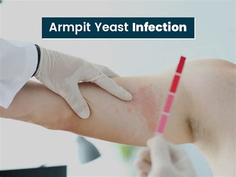 Can Yeast Infection Occur On Armpits Symptoms Causes And Prevention Tips You Should Know