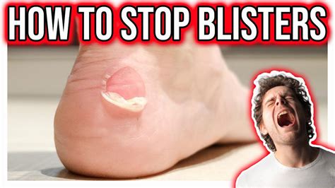 Blister Prevention How To Stop Blisters Youtube