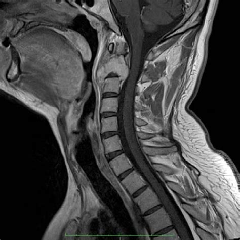 T1 Weighted Cervical Spine Mri Preoperative Sagittal And Axial Cut A