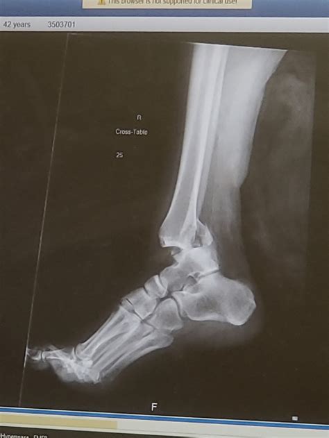 Compound Fracture Of Tibia And Fibula Recovery