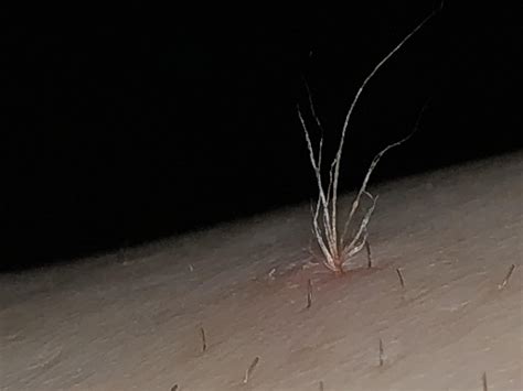 They result from blocked hair it's important to treat ingrown hairs correctly if you want to avoid complications such as bacterial. Extracting crazy ingrown hair. : popping