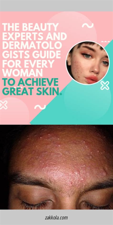 25 Natural Cystic Acne Treatments That Really Work Golden Home