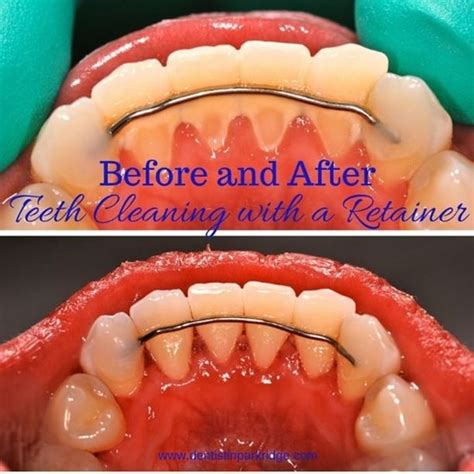 Smile Gallery Permanent Retainer Retainer Teeth Perfect Smile