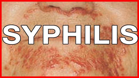 What Causes Syphilis Symptoms And Signs Treatment And Health Risks