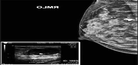 Ductal Carcinoma In A Multiple Fibroadenoma Diagnostic Inac