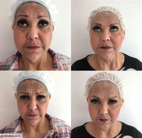 Lista 100 Foto Cirugia De La Cara Antes Y Despues El último
