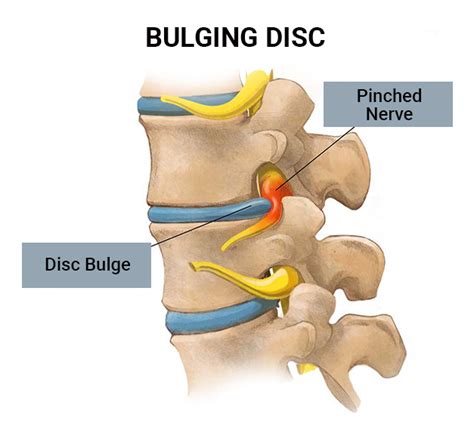 Cervical Slipped Disc Bulging Disc Doctors Nj Nyc